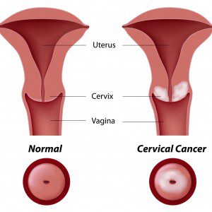 cervical dysplasia abnormal PAP smear