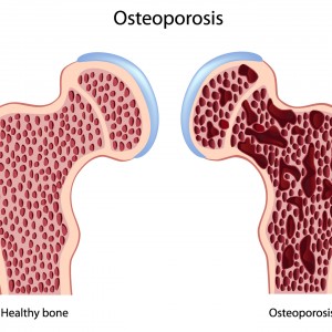 picture of bones showing healthy bone, osteoporosis and osteopenia