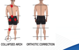 picture of orthotic correction