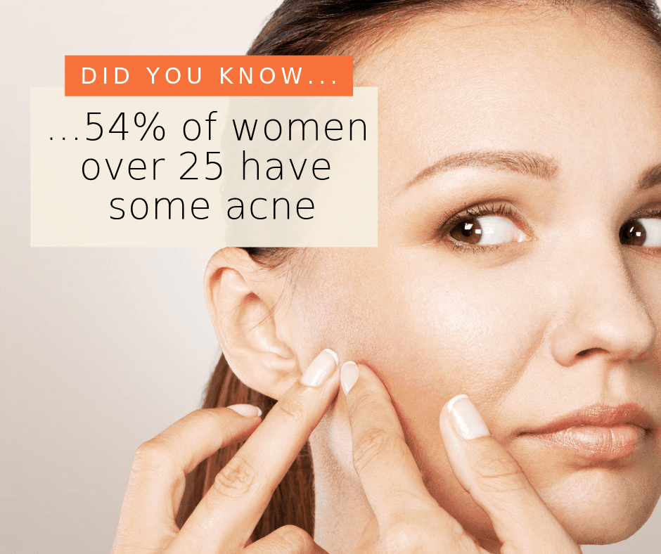 woman with acne squeezing her pimples